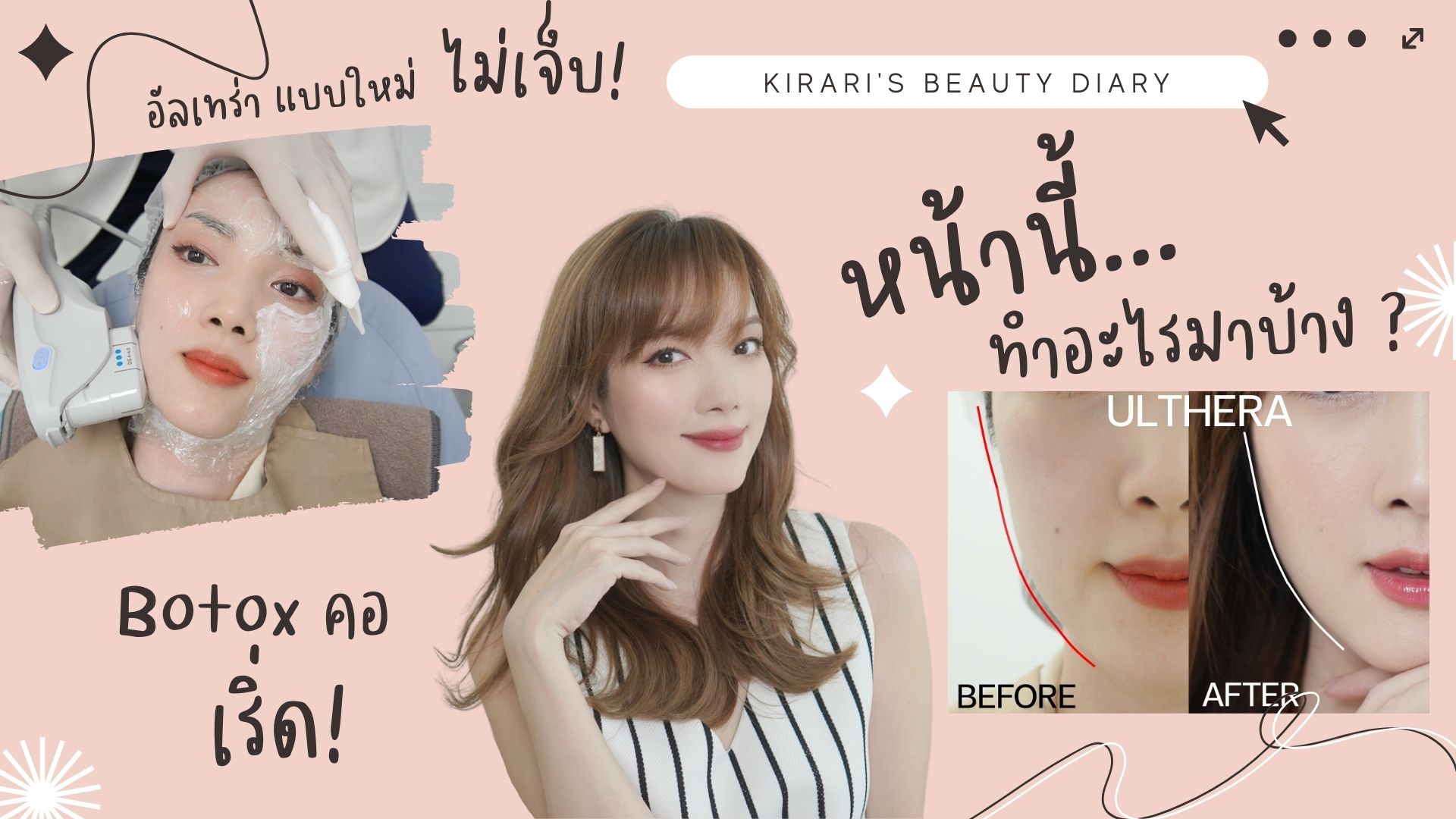 หน้านี้ทำอะไรมาบ้าง? Ulthera แบบใหม่ไม่เจ็บ | Botox คอ เริ่ดมากก ที่ THE DEMIS